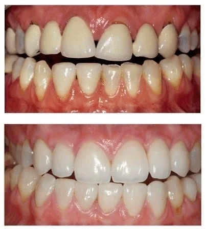 teeth before after