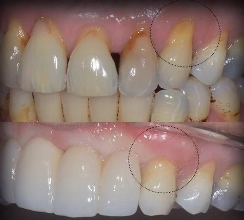 teeth before after