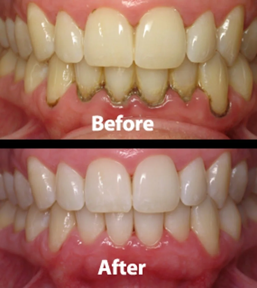 teeth before after